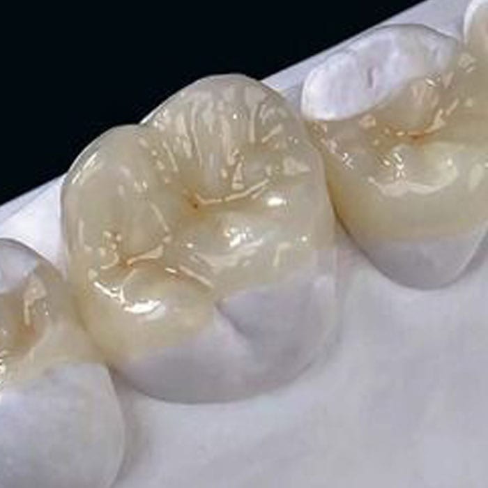 Inlays / Onlays Services - Dentist Bendigo