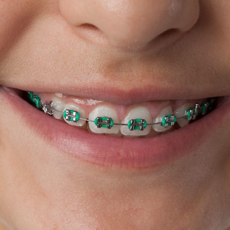 Orthodontics Service - Dentist in Bendigo