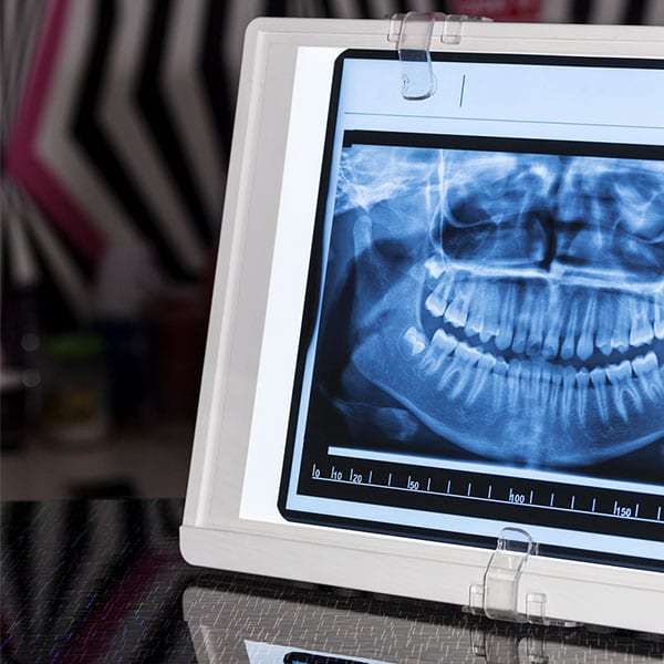 Periodontal Therapy Services - Dentist Bendigo