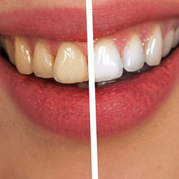 Teeth Whitening Services - Dentist in Bendigo
