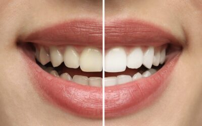 Teeth Whitening in Bendigo: What a Local Dental Clinic Offers