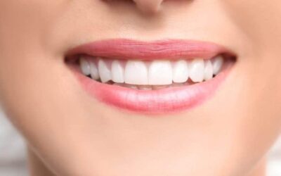 Thinking About Cosmetic Bonding? Here’s What You Should Know